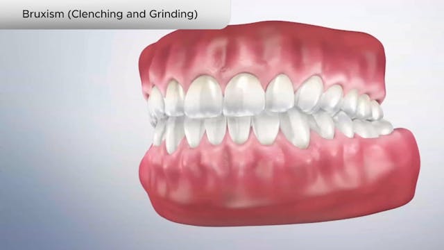 Bruxism (Clenching and Grinding) - Dental Patient Education Video