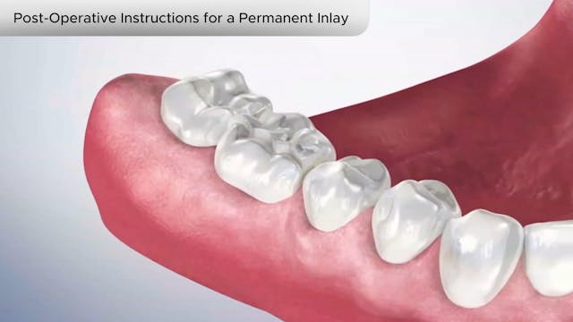 Post-Operative Instructions for Permanent Inlay - Dental Patient Education Video