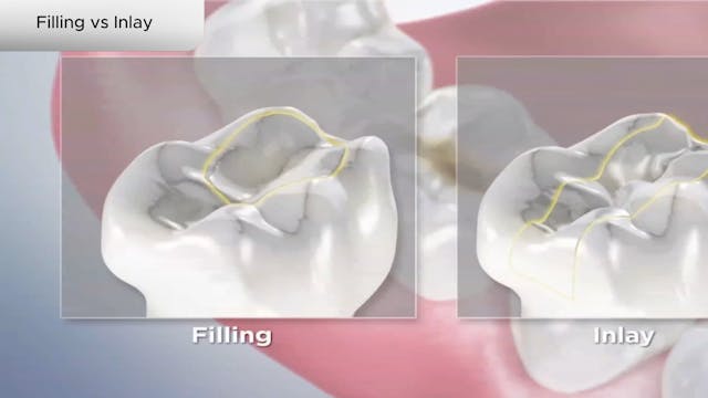 Filling vs Inlay - Dental Patient Education Video