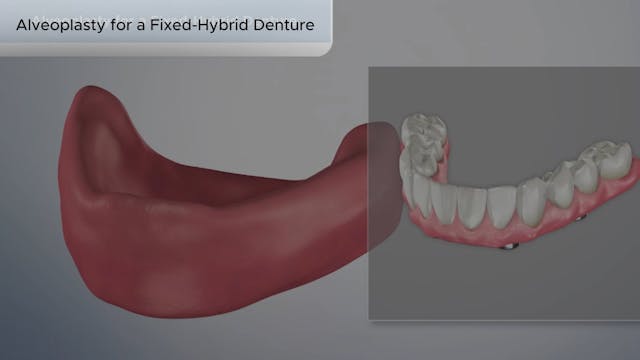 Alveoplasty for a Fixed-Hybrid Denture - Dental Patient Education Video