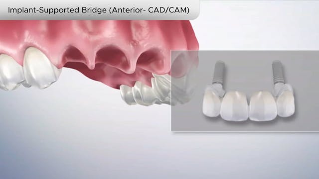 Implant-Supported Bridge (Anterior- CADCAM) - Dental Patient Education Video