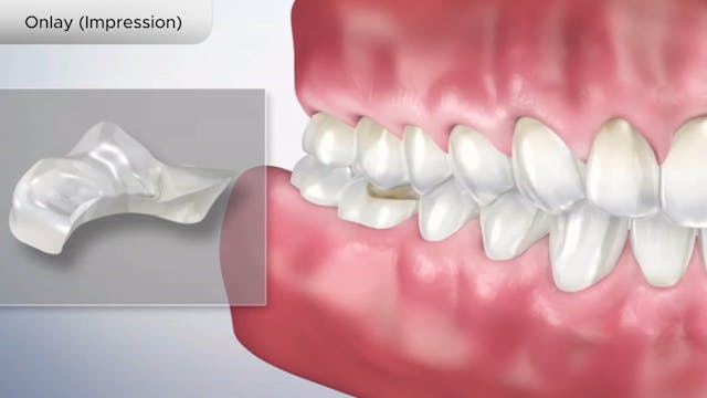 Onlay (Impression - Dental Patient Education Video