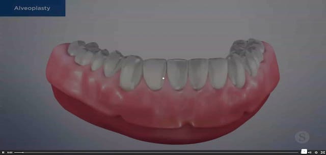 Alveoplasty - Dental Patient Education Video