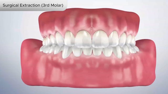 Surgical Extraction (3rd Molar) - Dental Patient Education Video