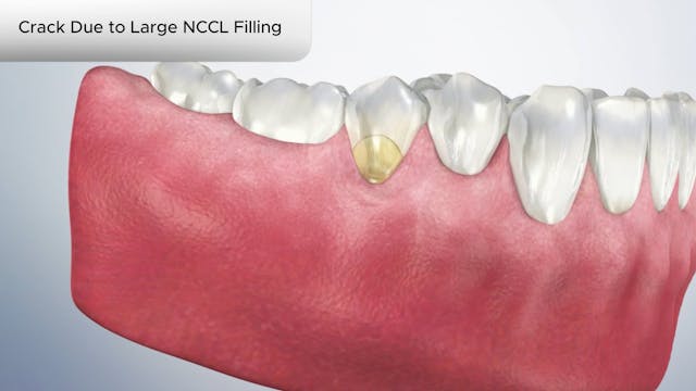 Crack Due to Large NCCL Filling - Dental Patient Education Video