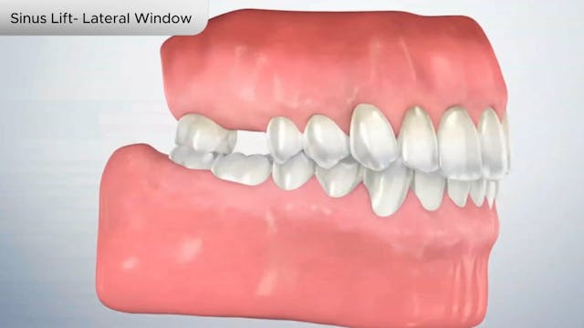 Sinus Lift- Lateral Window - Dental Patient Education Video