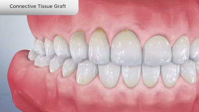 Connective Tissue Graft - Dental Patient Education Video