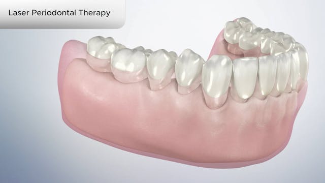 Laser Periodontal Therapy - Dental Patient Education Video