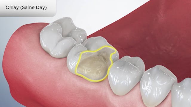 Onlay (Same Day) - Dental Patient Education Video