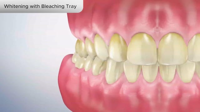 Whitening with Bleaching Tray - Dental Patient Education Video