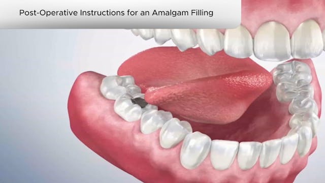 Post-Operative Instruction for an Amalgam Filling-Dental Patient Education Video