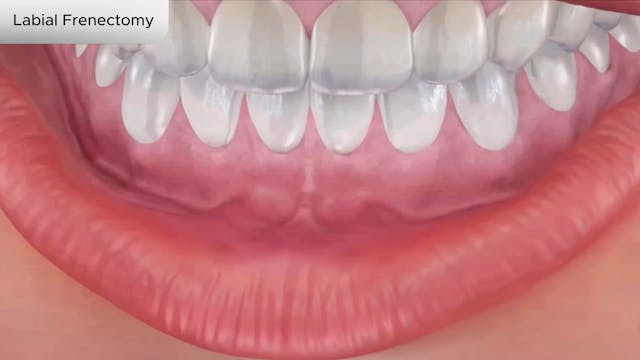 Labial Frenectomy - Dental Patient Education Video