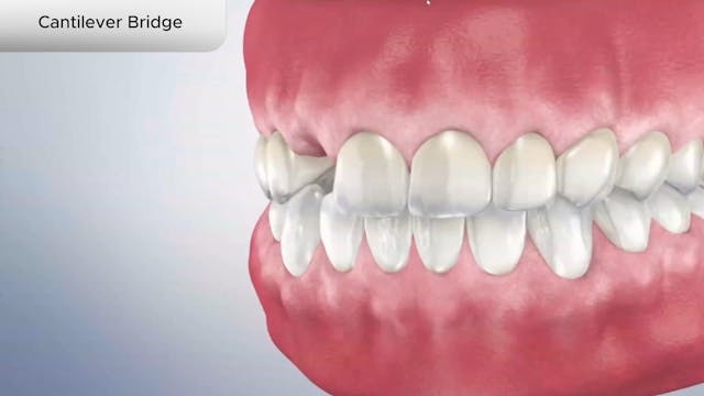 Cantilever Bridge - Dental Patient Education Video