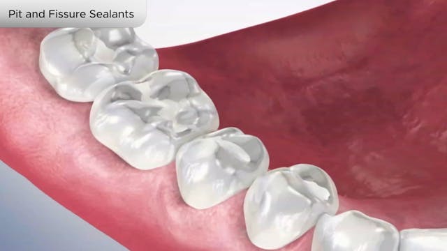 Pit and Fissure Sealants - Dental Patient Education Video