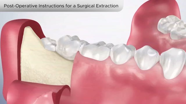 Post-Operative Instructions Surgical Extraction - Dental Patient Education Video