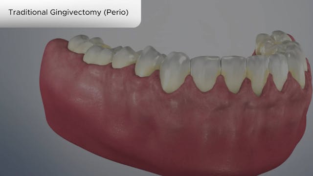 Traditional Gingivectomy (Perio) - Dental Patient Education Video