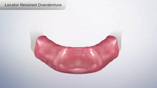 Locator Retained Overdenture - Dental Patient Education Video