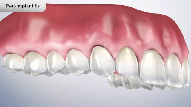 Peri-Implantitis - Dental Patient Education Video