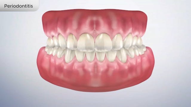 Periodontitis - Dental Patient Education Video