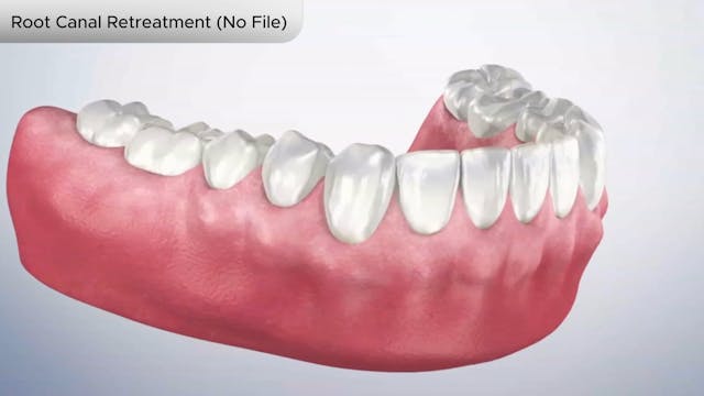 Root Canal Retreatment (No File) - Dental Patient Education Video