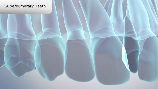 Supernumerary Teeth - Dental Patient Education Video