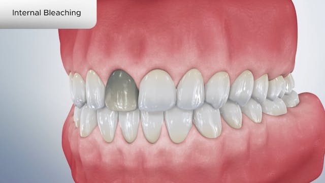 Internal Bleaching - Dental Patient Education Video