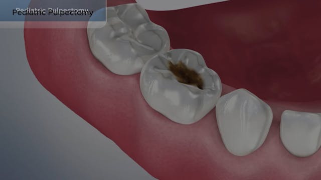 Pediatric Pulpectomy - Dental Patient Education Video