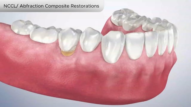 NCCL Abfraction Composite Restorations - Dental Patient Education Video