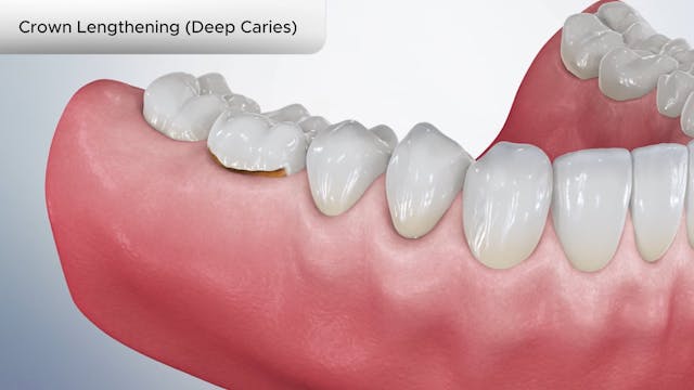 Crown Lengthening (Deep Caries) - Dental Patient Education Video