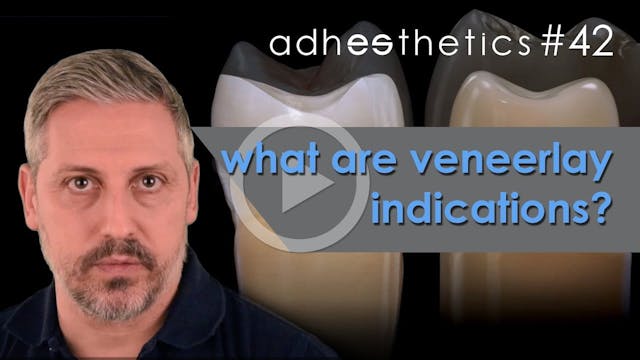 What are veneerlay indications Episod...