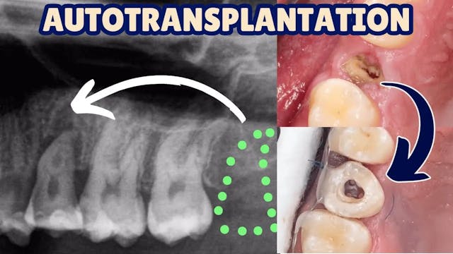 Understanding Auto Transplantation in...