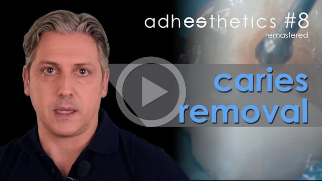 Caries Removal Episode #08 Adhestheti...