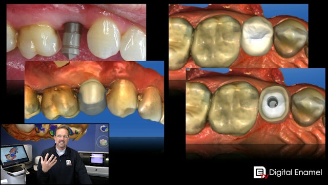 Split to Abutment and Crown Case