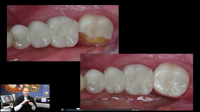 Using Fractured Restorations for Your...