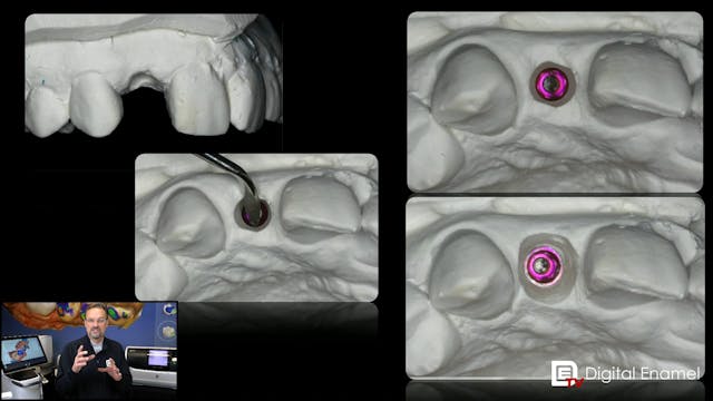 Stone Gingivectomy for Implants