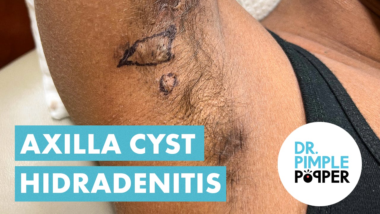 Cute Little Hidradenitis Bumps in Armpit Dr Pimple Popper Removes