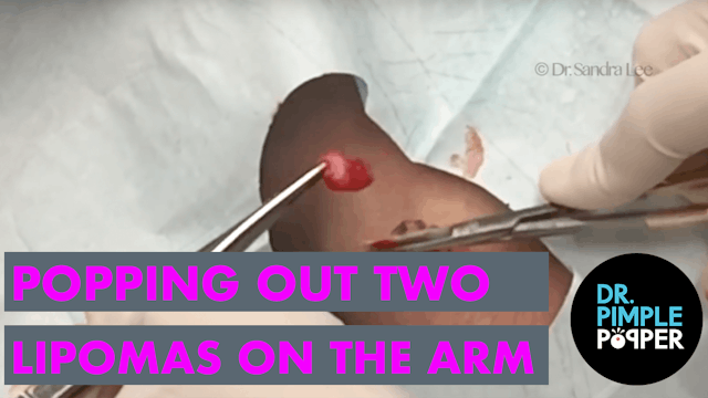 Popping Out Two Lipomas on the Arm