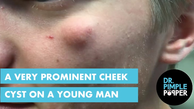 A very prominent cheek cyst in a young man
