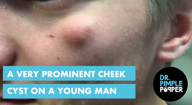 A very prominent cheek cyst in a youn...