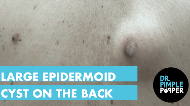 Large Epidermoid Cyst Excised on the ...