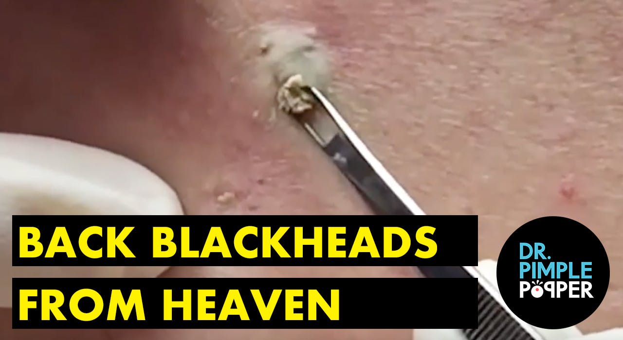 blackheads heaven pimple popper dr