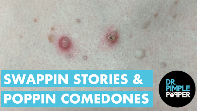 Swappin' Stories & Poppin' Comedones