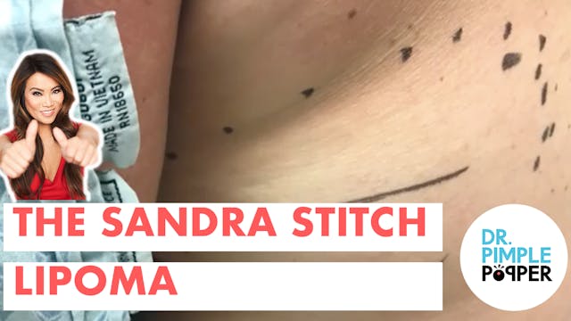 The Sandra Stitch Lipoma