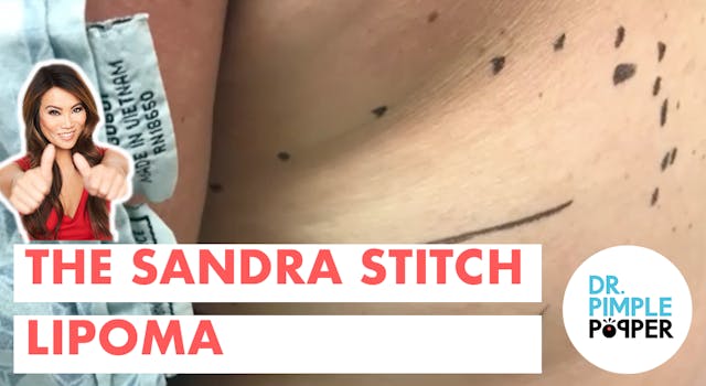 The Sandra Stitch Lipoma