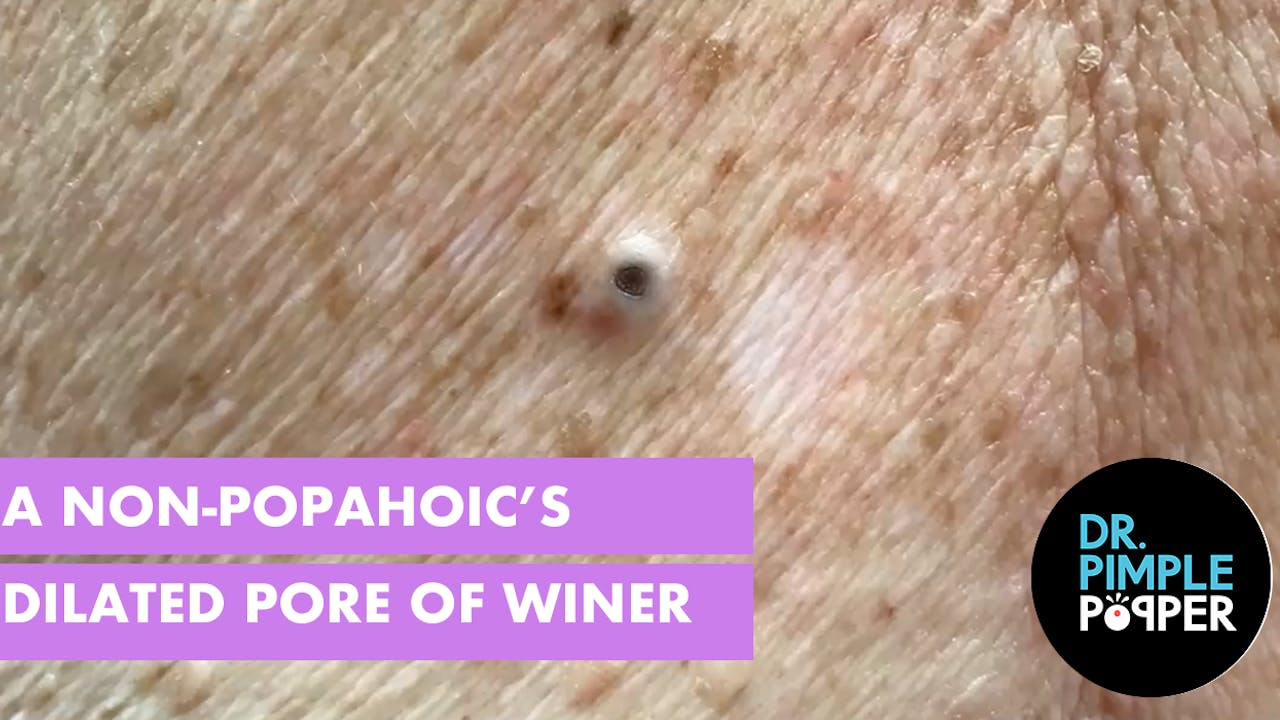 A Non-Popaholic's Dilated Pore of Winer - DPOW Superheroes - Dr. Pimple ...