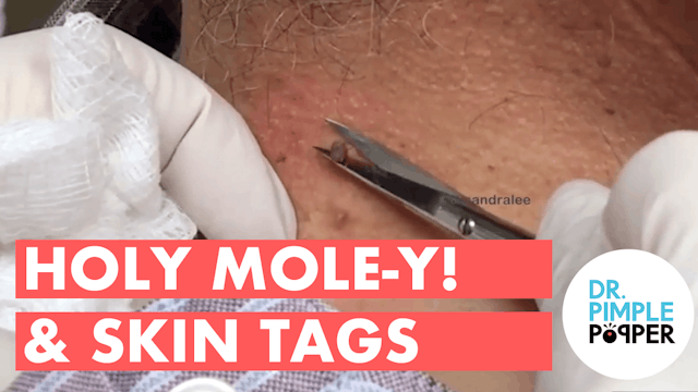 Holy MOLE-y! & Skin Tags