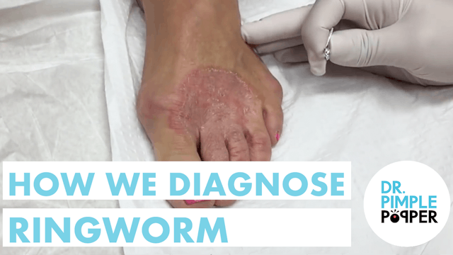How We Diagnose Ringworm