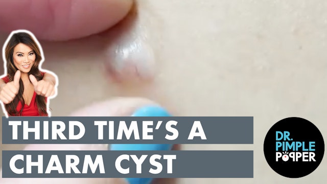 Third Time's A Charm Cyst