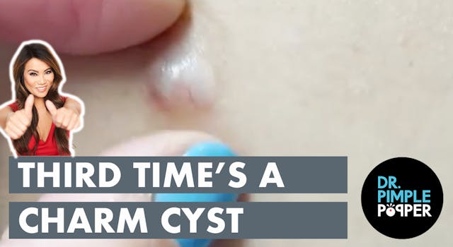Third Time's A Charm Cyst