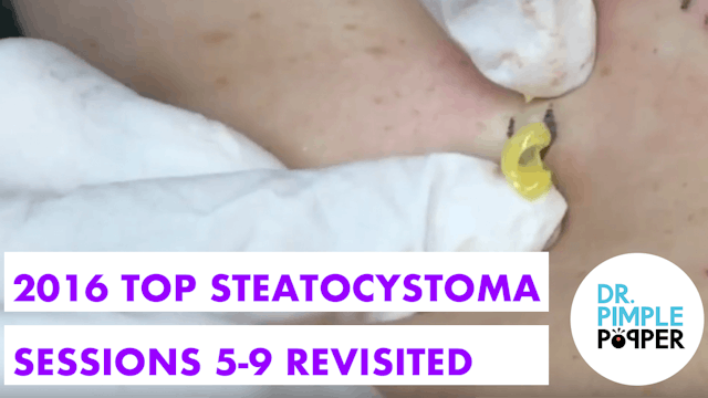 2016 Top Steatocystomas Sessions 5-9 ...
